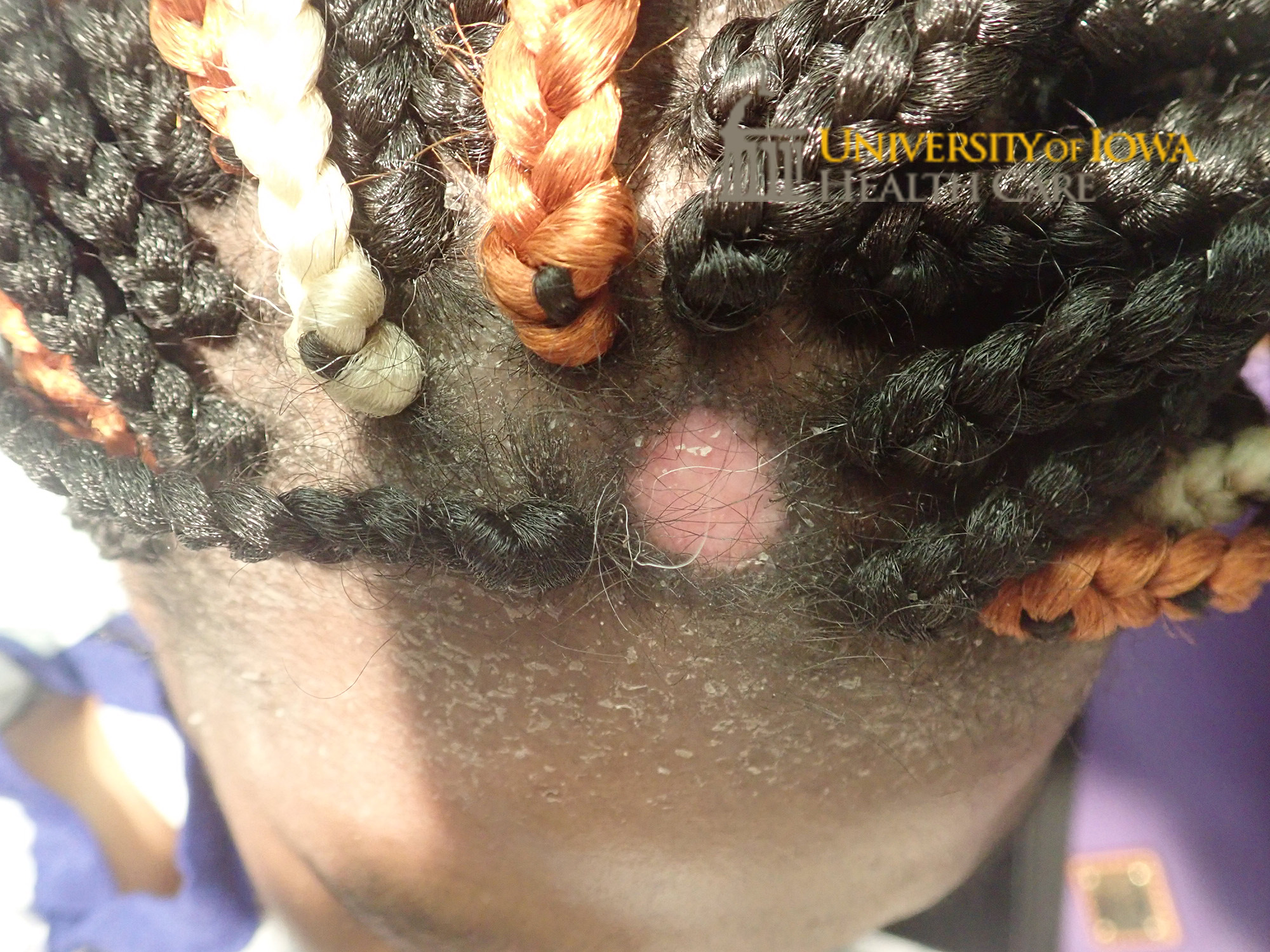 Well demaracated, shiny, and atrophic plaque with depigmentation and with rim of hyperpigmentation and surrounding scaling on the frontal scalp. (click images for higher resolution).